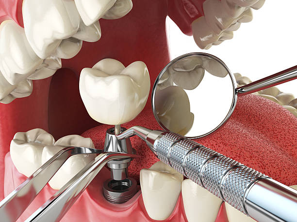 Best Emergency Tooth Extraction in Hurley, WI