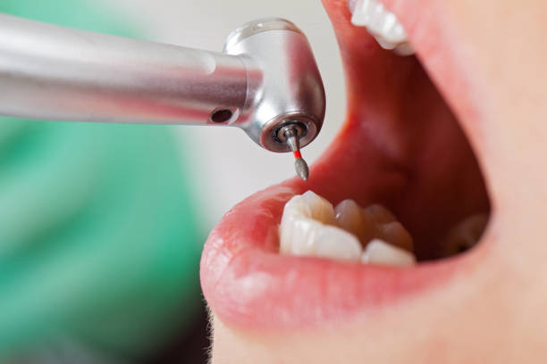 Best Emergency Dental Care for Broken or Chipped Teeth in Hurley, WI